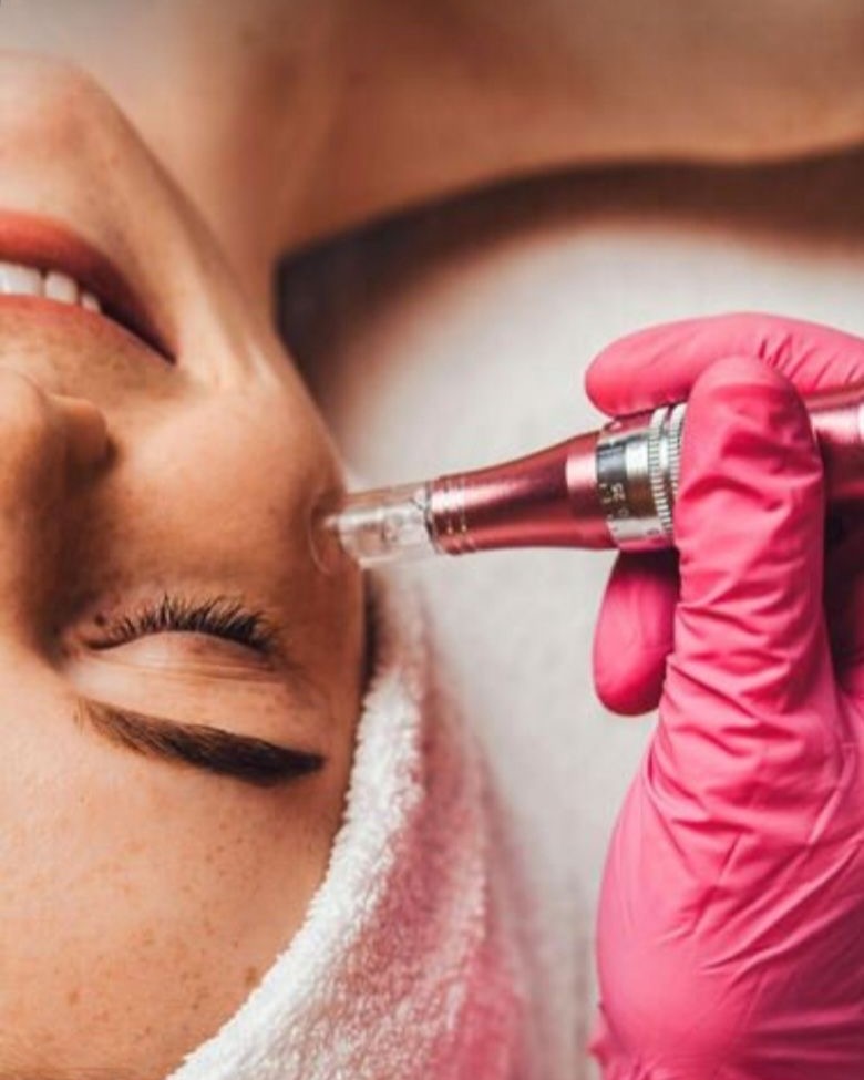 Microneedling