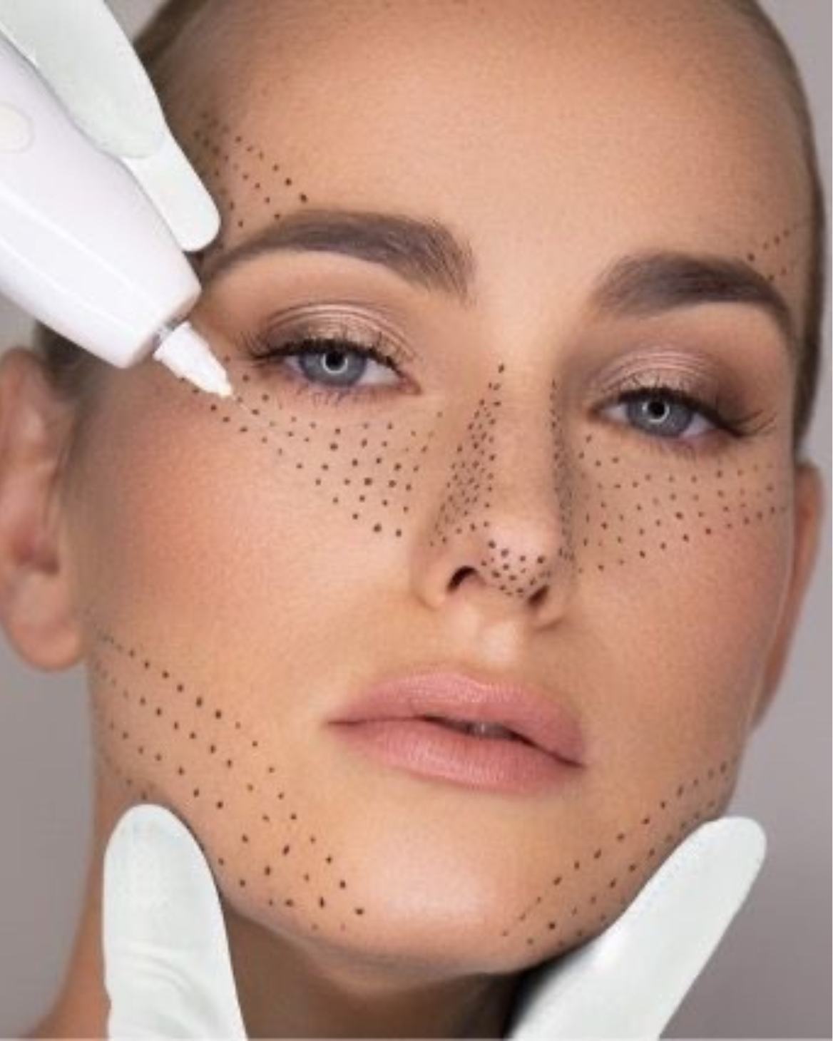 Plasma Skin Tightening